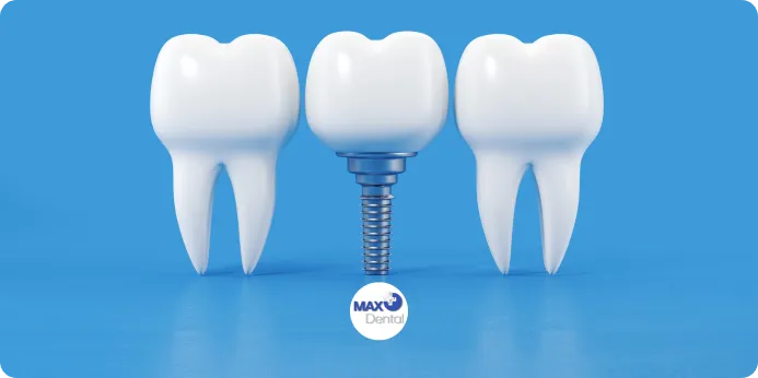 چگونه قیمت ایمپلنت دندان را محاسبه کنیم؟