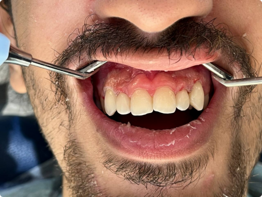 بعد از بلیچینگ