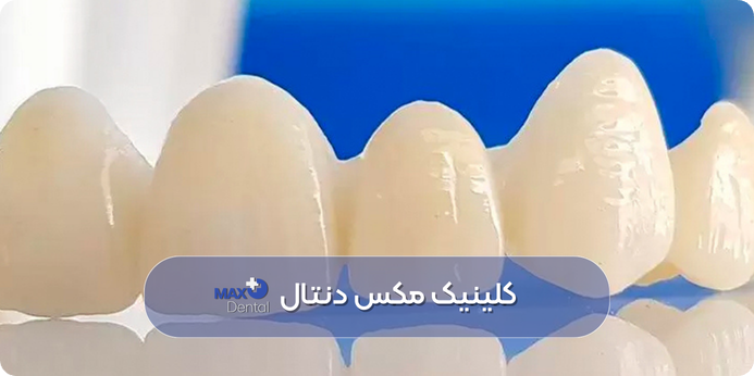 روکش زیرکونیا چیست و چه مزایایی دارد؟