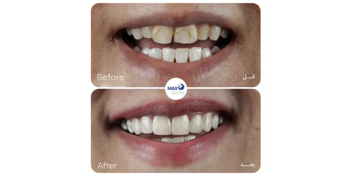 قیمت کامپوزیت چگونه محاسبه می شود؟