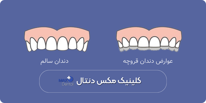 اختلالات خواب و نقش آن‌ها در دندان قروچه یا براکسیسم شبانه کودکان چیست؟