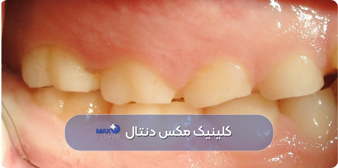 عوارض دندان قروچه برای سلامت دهان و دندان کودک