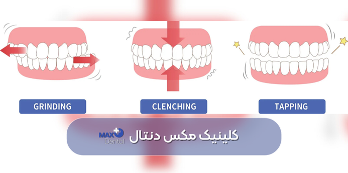 آشنایی با سایر علت های براکسیسم شبانه