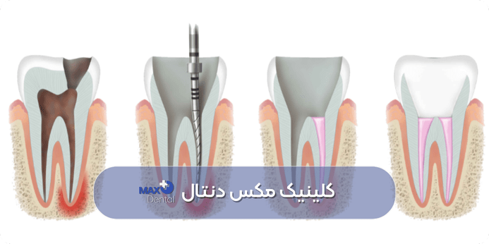 میزان موفقیت درمان ریشه دندان چقدر است