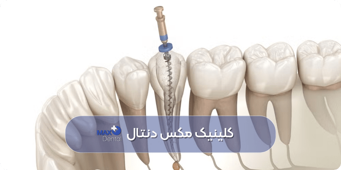 عوارض، خطرات احتمالی و دلایل نیاز به عصب کشی مجدد دندان