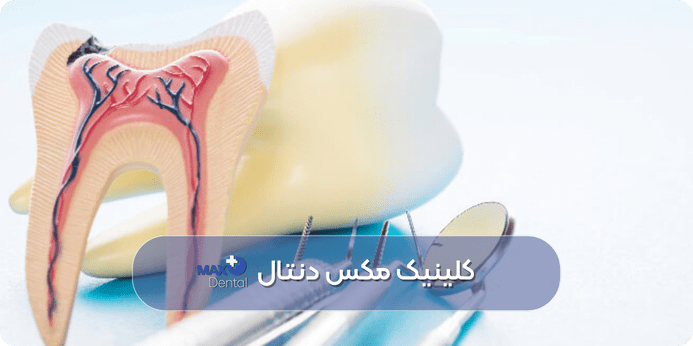 راه های پیشگیری از نیاز به عصب کشی دندان