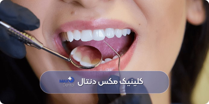 راهنمای مراقبت های بعد از ترمیم دندان