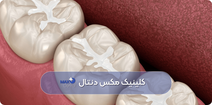 طول عمر کامپوزیت دندان