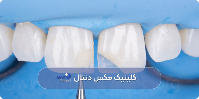 دلایل نارضایتی و پشیمانی از کامپوزیت دندان و پیشگیری