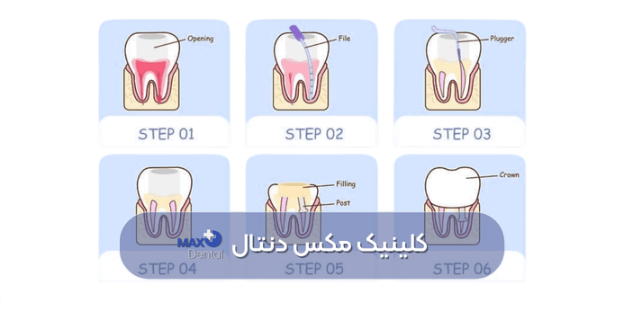 تمام مراحل عصب کشی دندان