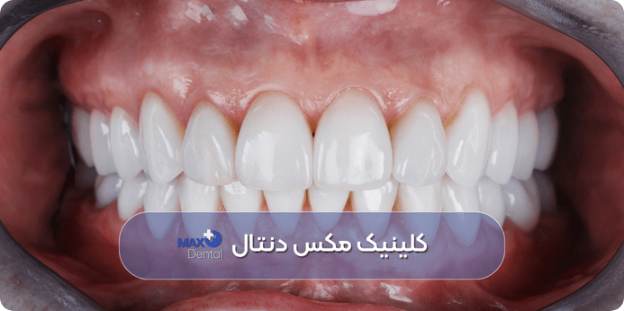 روش‌ های تخصصی (دندانپزشکی) برای سفید شدن دندانهای زرد در یک روز
