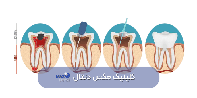 مراحل عصب کشی دندان چقدر طول میکشد