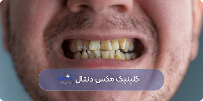 علت‌ ها و عوامل مؤثر در زرد شدن دندان‌ ها