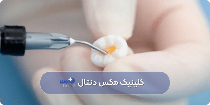 کامپوزیت دندان چگونه است