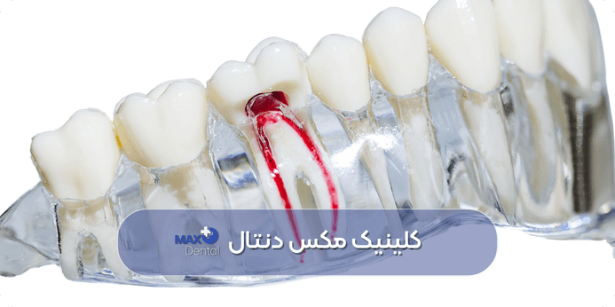 انواع روش های عصب کشی دندان