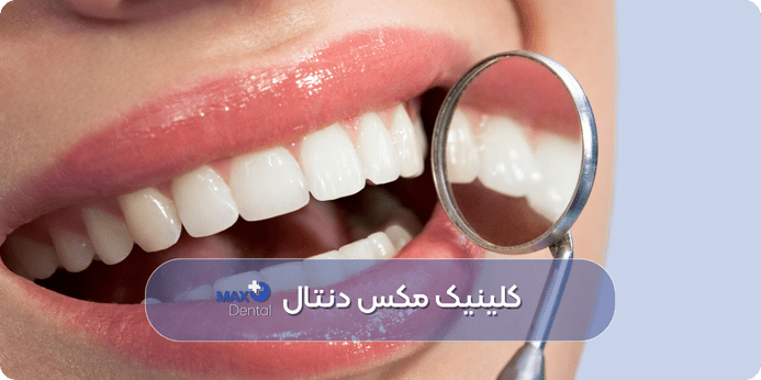 نکات مهم پیش از اقدام برای سفید کردن دندان