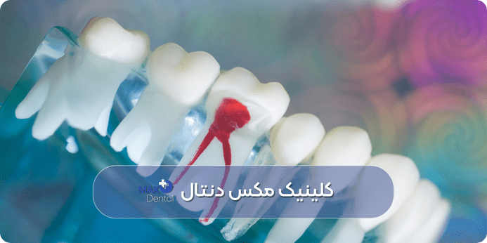 نحوه ترمیم دندان پس از عصب کشی