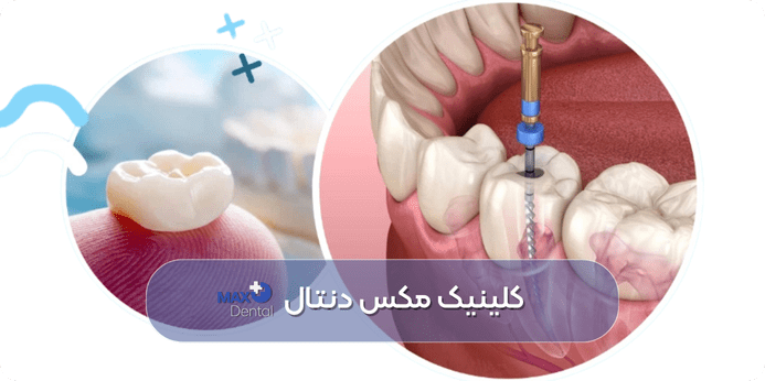 مراقبت های بعد از عصب کشی دندان