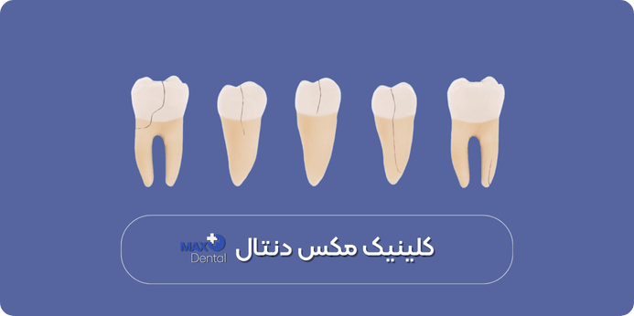 آشنایی با انواع شکستگی دندان