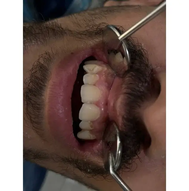 نمونه بلیچینگ 2