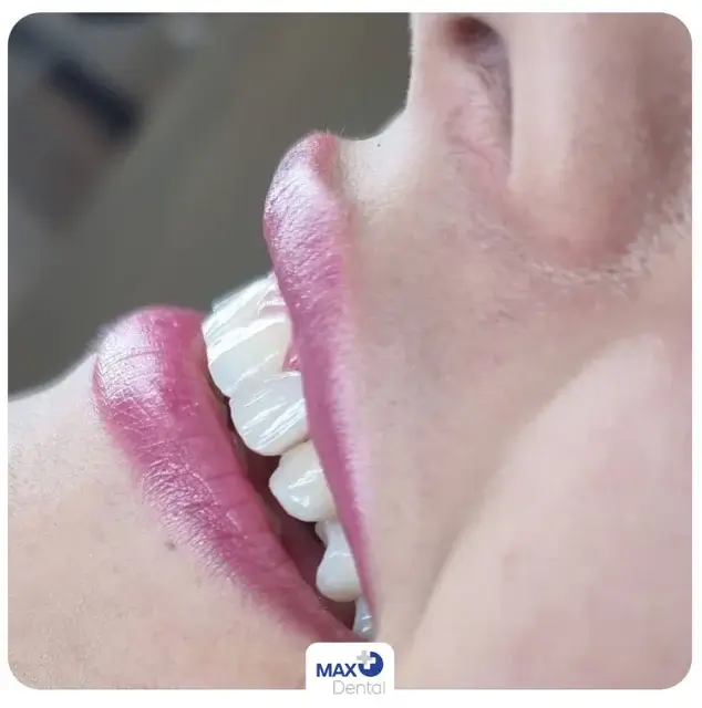 نمونه کار کامپوزیت