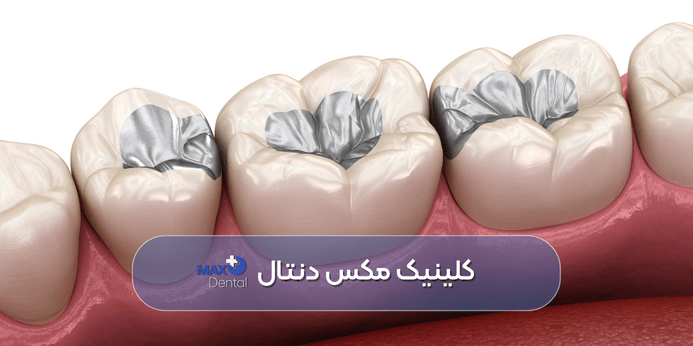 طول عمر انواع مختلف مواد پرکننده