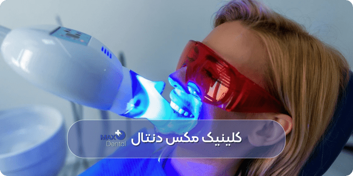 مراحل بلیچینگ دندان با دستگاه LED