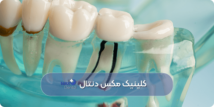 درمان ریشه (عصب‌ کشی) چه زمانی لازم است
