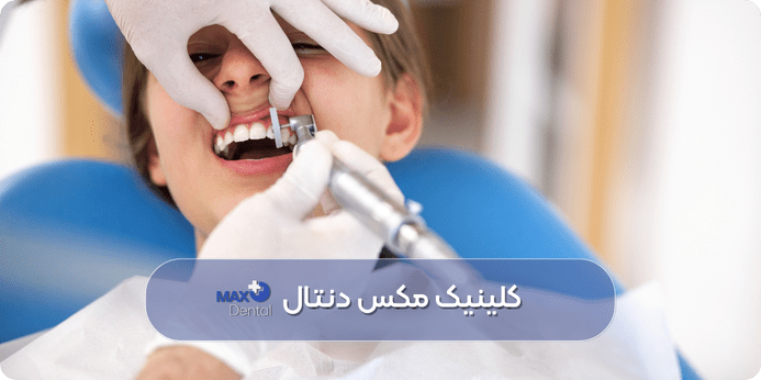 روت پلنینگ یا جرم گیری عمیق چیست 