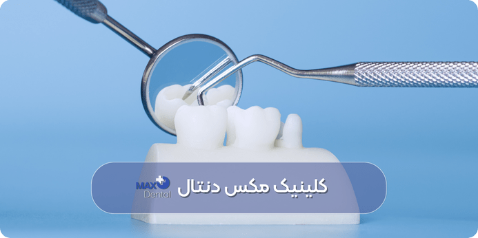 نحوه تشخیص ترمیم دندان خراب شده یا نیازمند تعویض