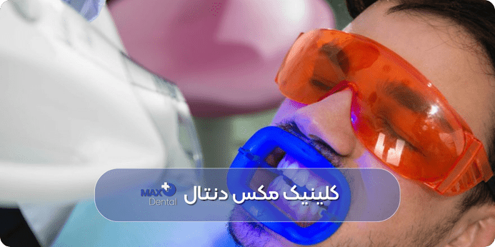 هزینه بلیچینگ دندان چقدر است و به چه عواملی بستگی دارد