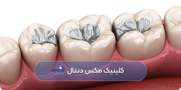 عمر انواع مختلف مواد پرکننده
