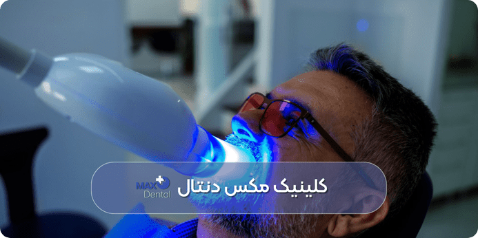 آیا بلیچینگ دندان عصب کشی شده امکان پذیر است
