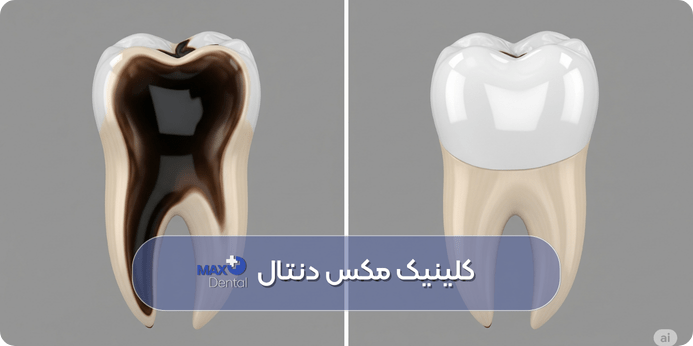 بهترین ماده برای پر کردن دندان