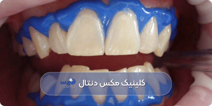 هر چند وقت یکبار می توان بلیچینگ دندان را تکرار کرد
