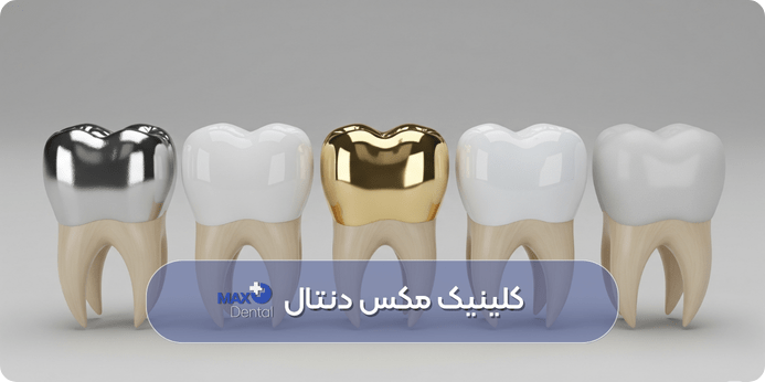 انواع مواد پرکننده دندان