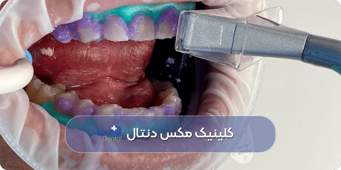 در چه زمانی بلیچینگ دندان نتایج بهتری می دهد