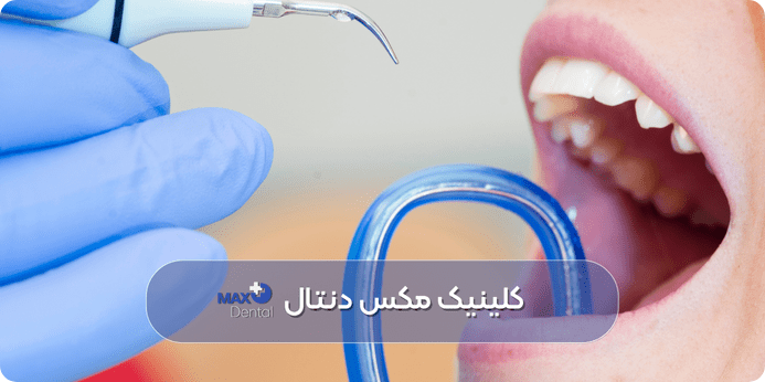 پر کردن دندان در دوران بارداری