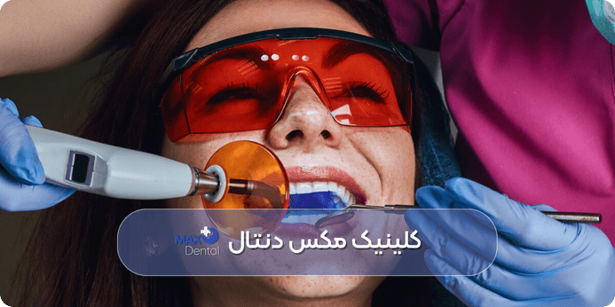 مراحل بلیچینگ دندان با لیزر