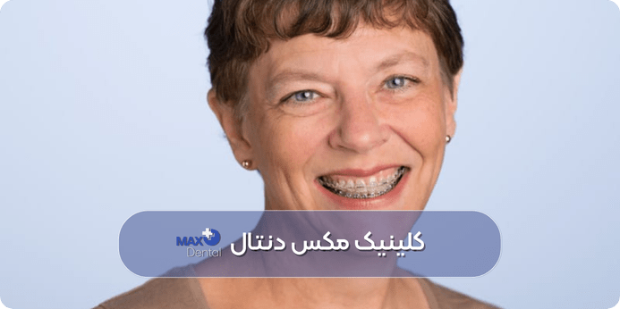  ارتودنسی در سنین بالا (آیا ارتودنسی در ۴۰ سالگی ممکن است)