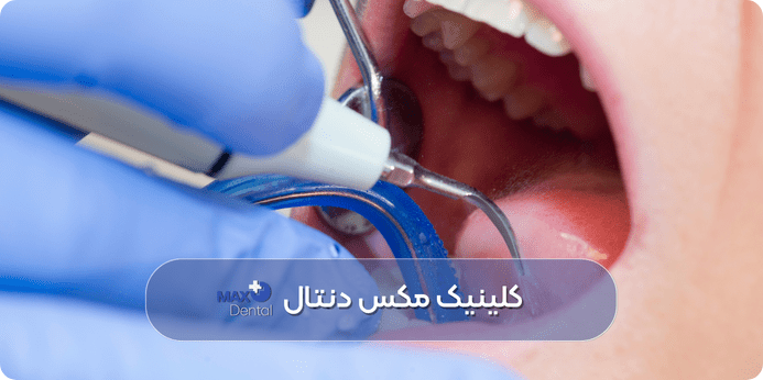 پر كردن دندان بدون عصب كشي