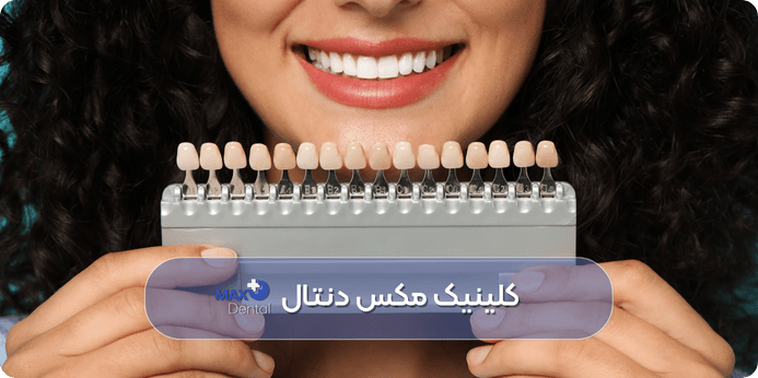 لمینت دندان چیست و چه زمانی برای ترمیم به آن نیاز دارید