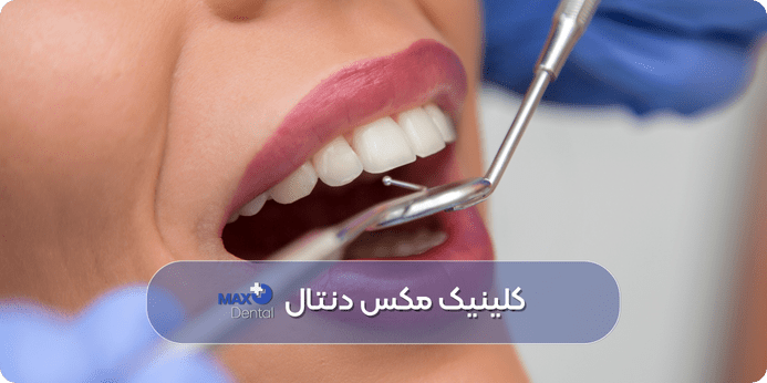 مراقبت های بعد از جرمگیری دندان