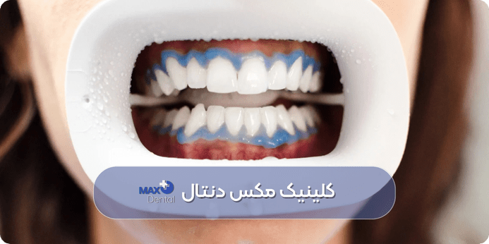 مراحل بلیچینگ شیمیایی ( روش کلاسیک سفید کردن دندان)