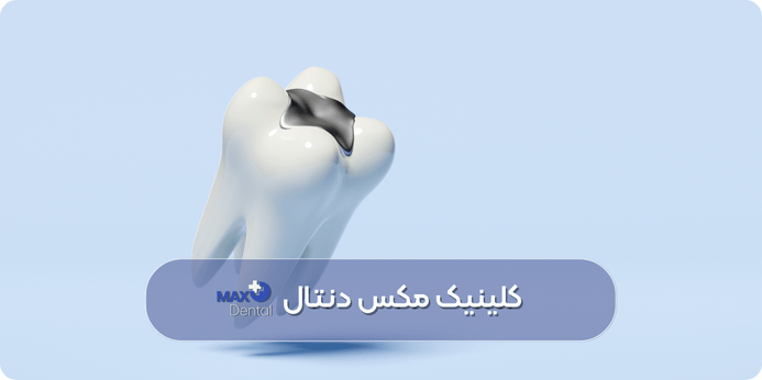 مراقبت های پس از پر کردن دندان برای افزایش طول عمر ترمیم