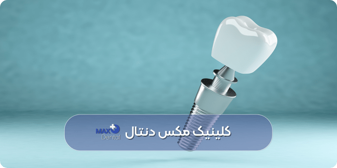 ایمپلنت دندان (بهترین جایگزین برای دندان از دست رفته)