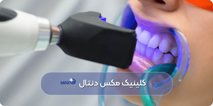 مزایا و معایب بلیچینگ دندان چیست