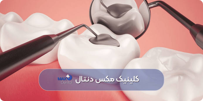 عوارض و مشکلات احتمالی بعد از پر کردن دندان و راه های مقابله با آن ها