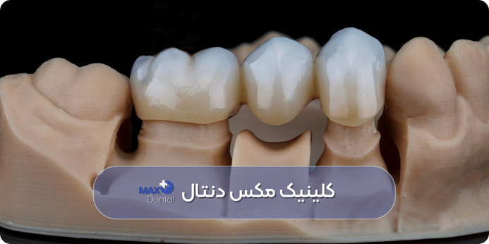 بریج دندان چیست و چه کاربردی دارد