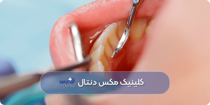 فاصله زمانی مناسب برای تکرار جرم گیری